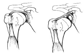 SLAP артроскопия плечо плечевой сустав